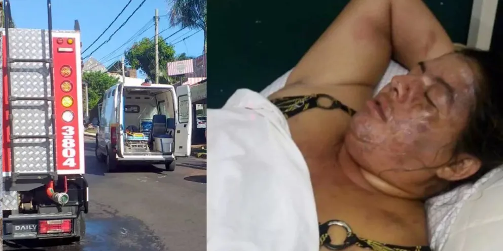 Un hombre le tiró sopa hirviendo a su pareja: tiene el 80% de la cara quemada  