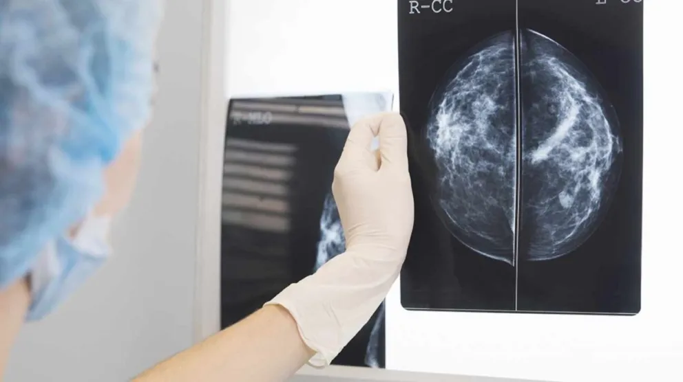 Gran avance: un medicamento frena el cáncer de mama en el 75% de los pacientes