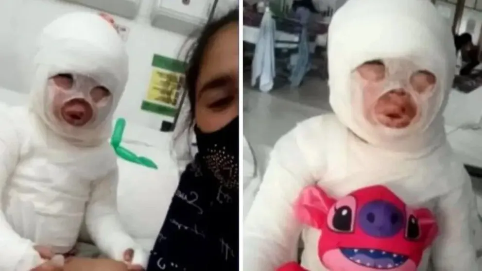 Horror en Florencio Varela: le volcaron aceite hirviendo a una nena de 3 años en un restaurante