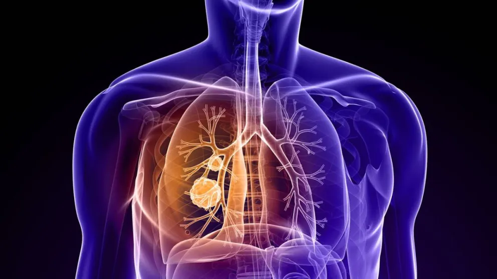 Aprobaron un nuevo fármaco para tratar un tipo agresivo de cáncer de pulmón 