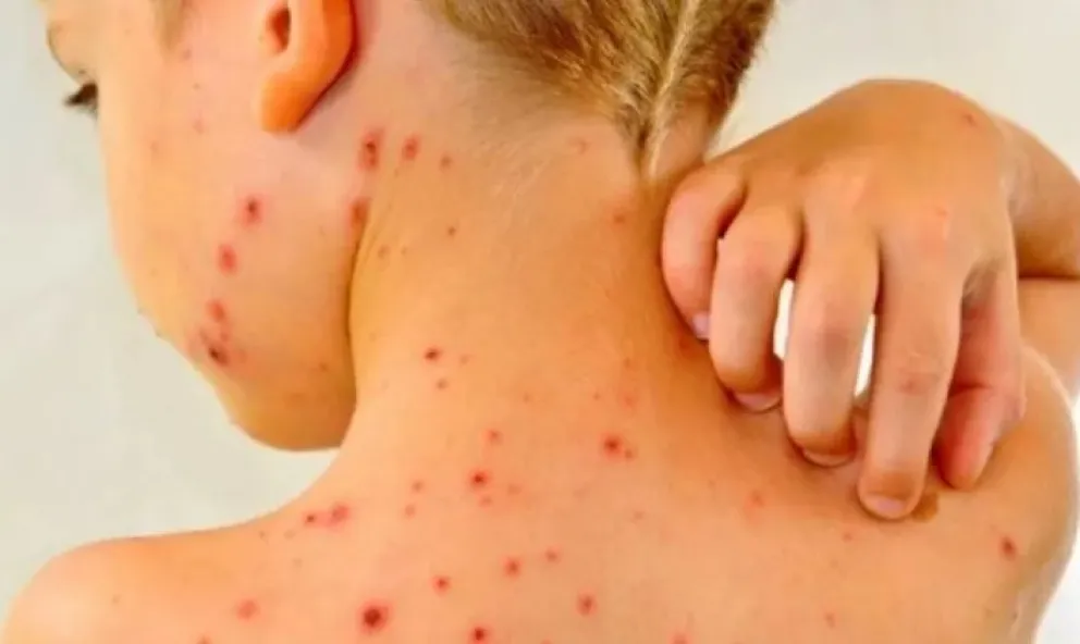Alerta de la OMS por el aumento de casos graves de sarampión en todo el mundo 